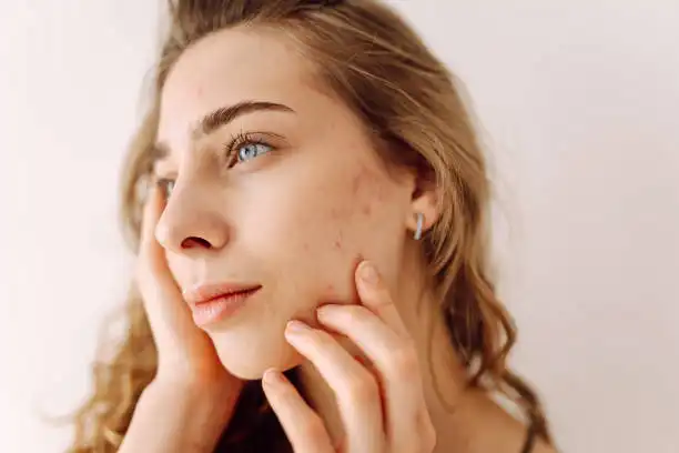 Is Vitamin C good for spots?